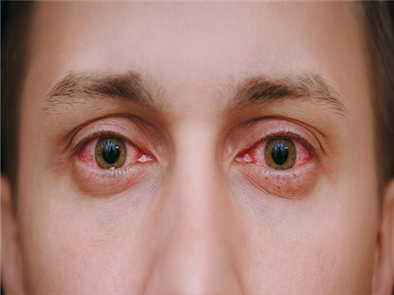 Làm gì khi có hiện tượng đỏ mắt?
